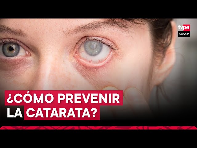 ⁣Alarma por catarata: el 50 % de pacientes que perdieron la visión fue por este mal