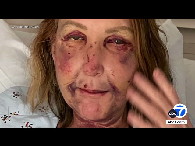 ⁣Woman who was assaulted near Venice Canals files claim against city of LA