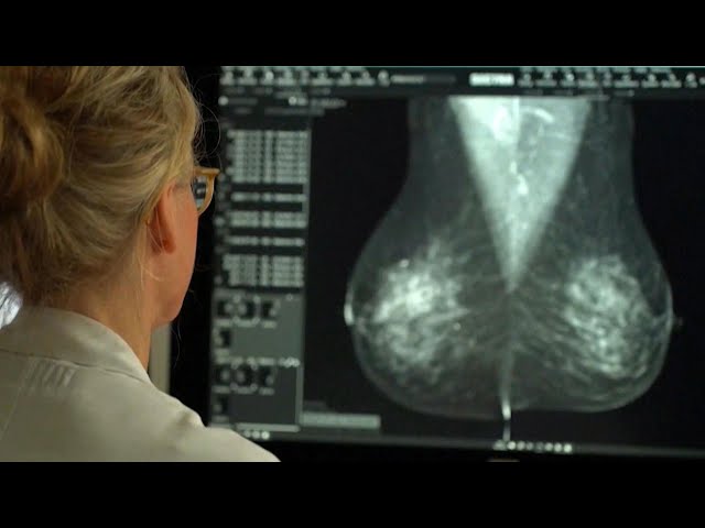 ⁣Why this Ontario doctor is calling lowering the breast screening age a 'win-win'