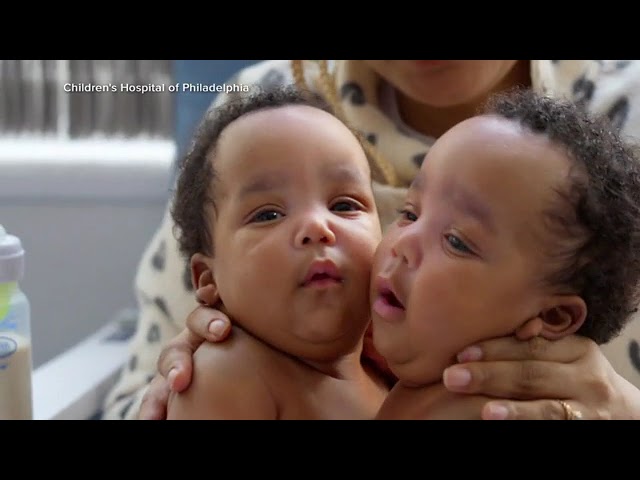 ⁣Twin brothers born conjoined celebrate 1st birthday after separation surgery