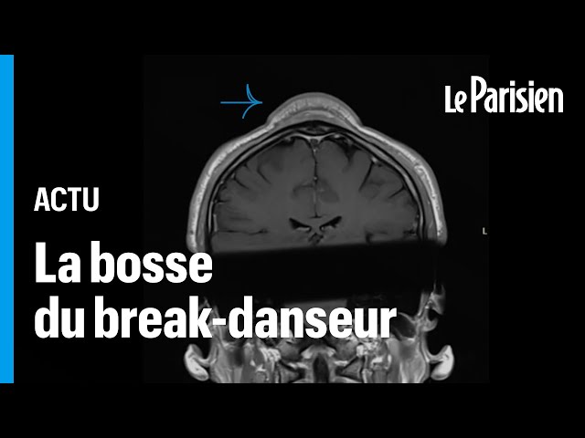 ⁣Un b-boy se fait retirer une tumeur au crâne due à une accumulation de « headspins »