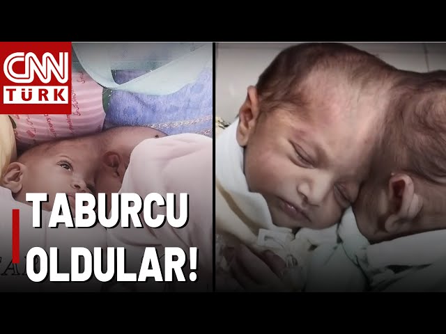 ⁣Siyam İkizleri Taburcu Oldu! Pakistanlı İkizler Sağlığına Kavuştu