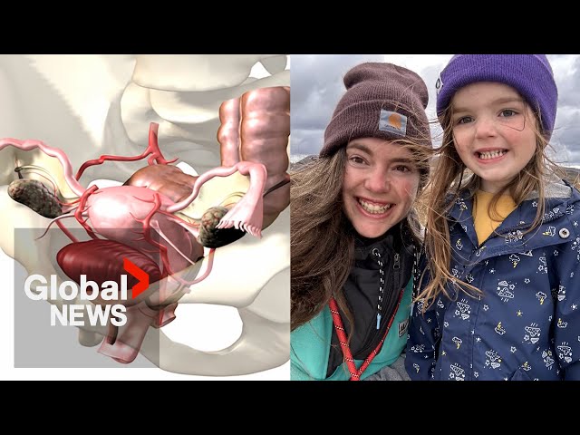 ⁣Nova Scotian woman travels to US for endometriosis surgery