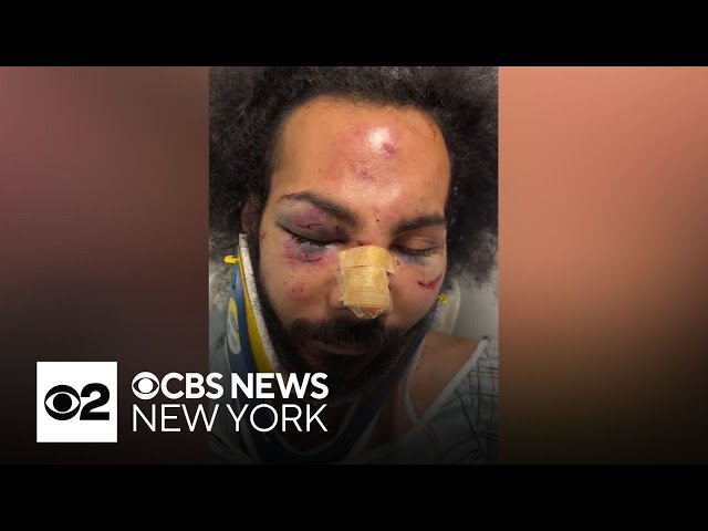 ⁣Man left with broken nose, other injuries after random NYC subway attack