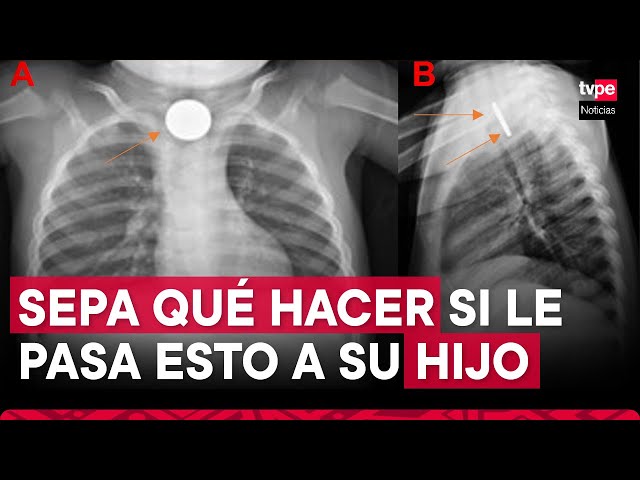 ⁣¿Tu hijo ingirió un cuerpo extraño? ¡Estas recomendaciones le salvarán la vida!