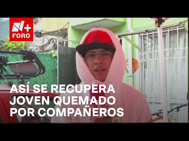 ⁣Cristian, joven quemado por sus compañeros de clase, se recupera - Las Noticias