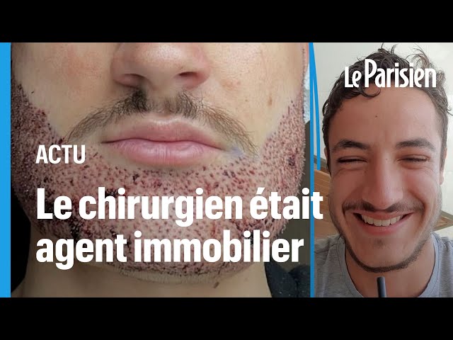 ⁣Jacques a perdu son fils après une greffe de barbe ratée en Turquie