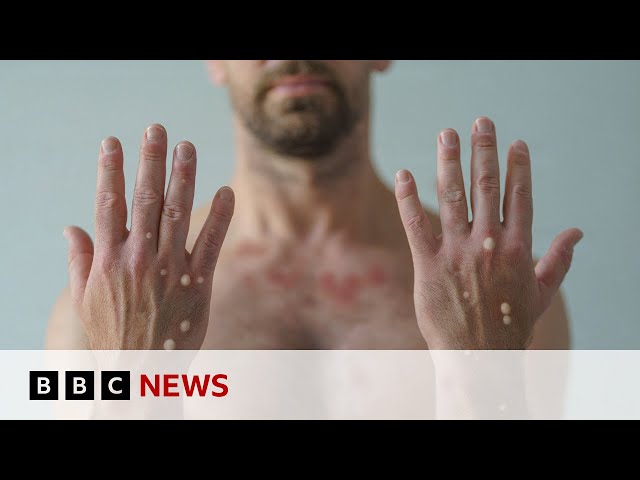 ⁣First case of more spreadable mpox detected in UK | BBC News