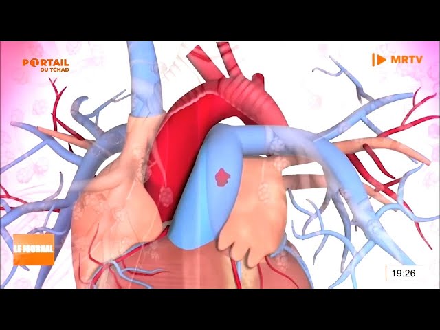 ⁣SANTÉ - Journée Mondiale de la Pneumonie