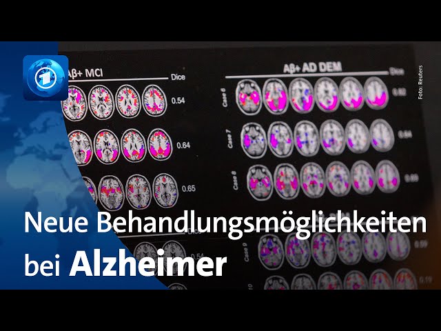 ⁣Alzheimer-Medikament vor Zulassung in der EU