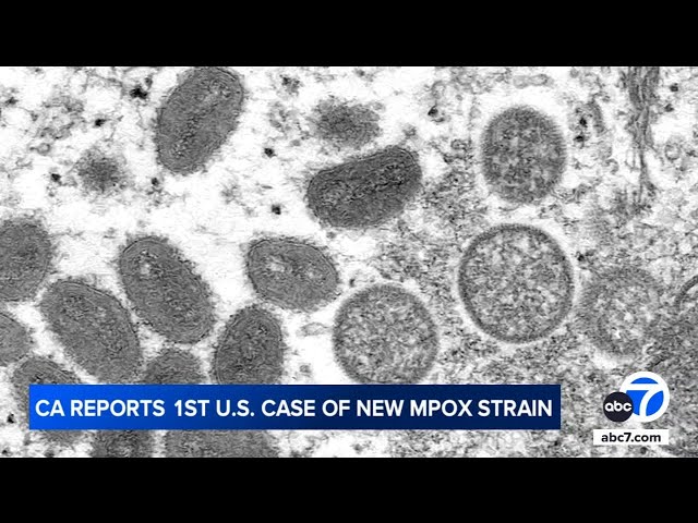 ⁣1st known US case of new strain of mpox is confirmed in California