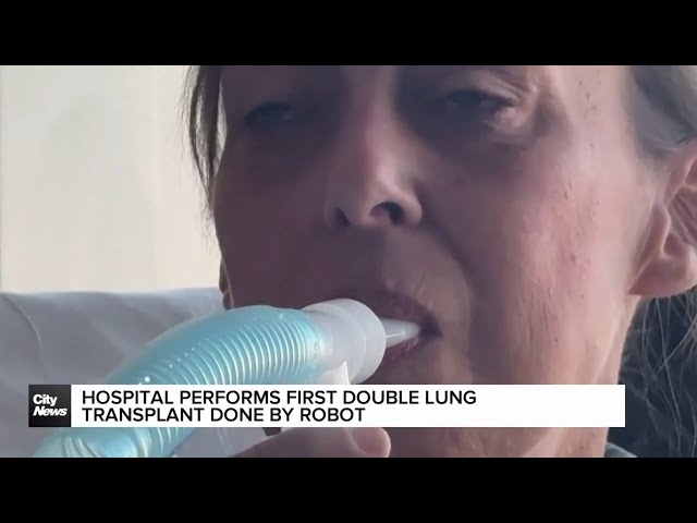 ⁣Hospital performs first double lung transplant done by robot