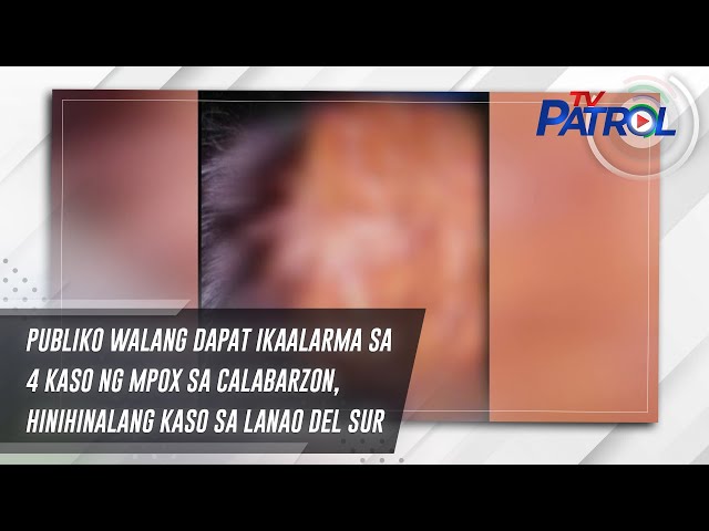 ⁣Publiko walang dapat ikaalarma sa 4 kaso ng mpox sa Calabarzon, hinihinalang kaso sa Lanao del Sur