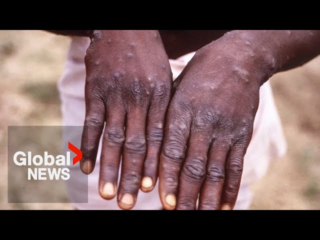 ⁣First Canadian case of more severe mpox strain confirmed in Manitoba