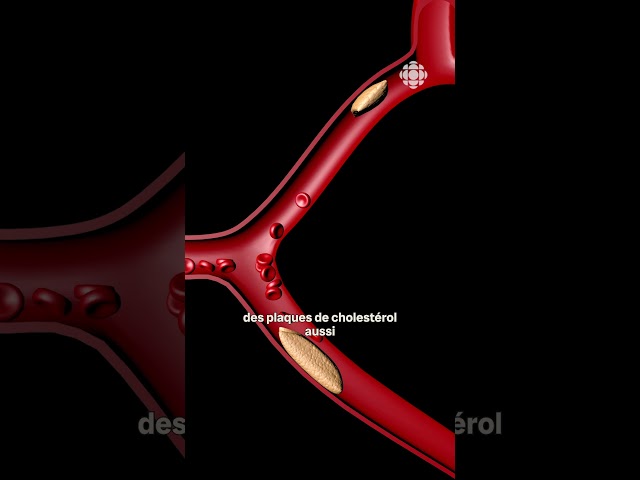 ⁣Comprendre les anévrismes cérébraux