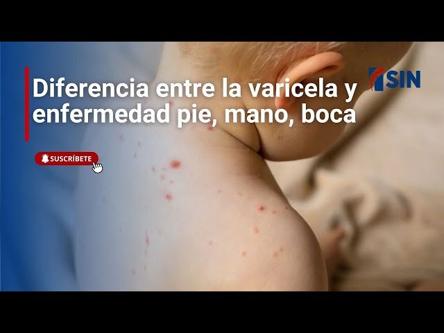 ⁣Diferencia entre la varicela y enfermedad pie, mano, boca