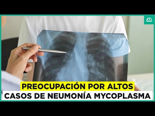 ⁣Bacteria agravaría síntomas de neumonía mycoplasma