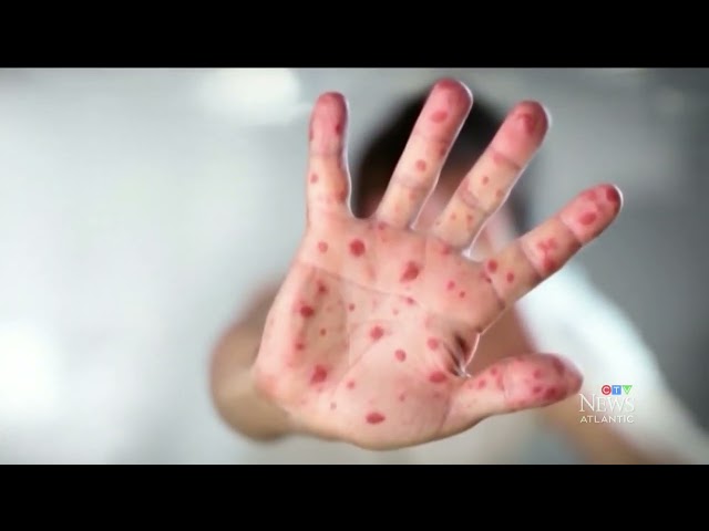 ⁣50 confirmed measles cases in N.B. as outbreak worsens