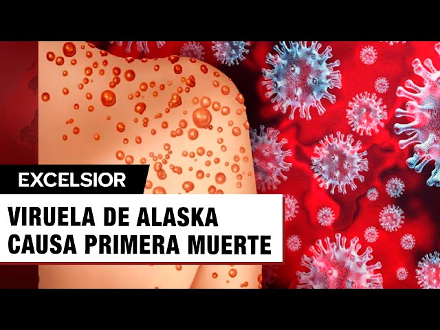 ⁣Viruela de Alaska activa emergencia; primera víctima mortal