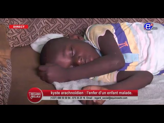 ⁣Kyste arachnoïdien: l'enfer d'un enfant malade