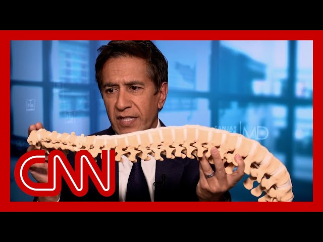 ⁣Sanjay Gupta gives demonstration on Mangione's apparent spine condition