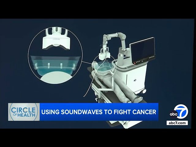 ⁣Histotripsy treatment kills cancer cells with sound. Here's how it works