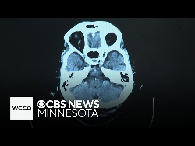 ⁣New Alzheimer's treatment gives Minnesota patient hope