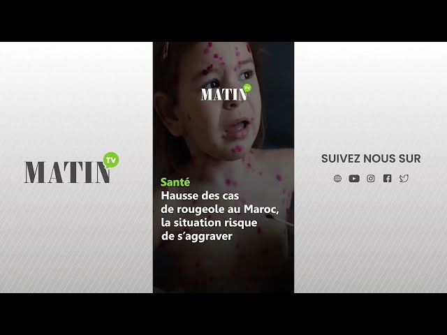 ⁣Santé : Hausse des cas de rougeole au Maroc, la situation risque de s'aggraver