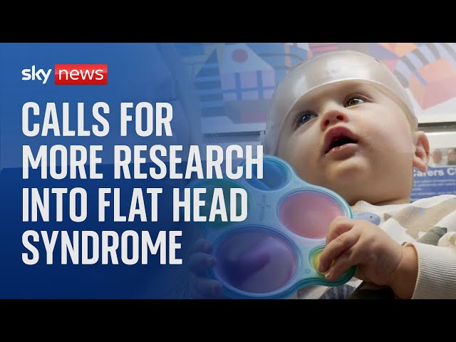 ⁣Calls for more research into flat head syndrome in babies and whether helmet therapy works