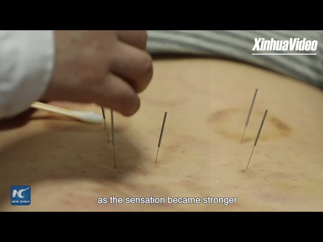 ⁣Acupuncture: Ancient healing for modern lives