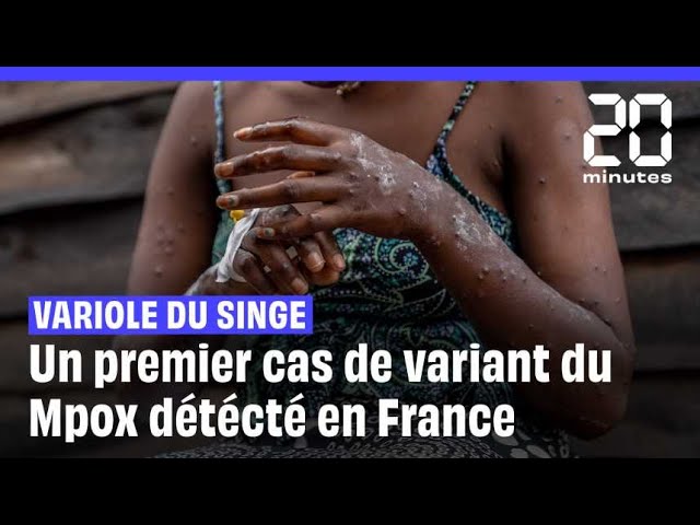 ⁣Mpox : Le tout premier cas du nouveau variant identifié en France à Rennes