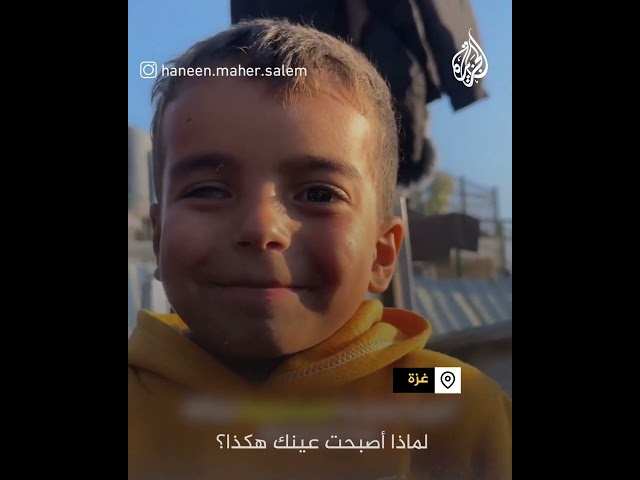 ⁣طفل يحلم بأن يكون طبيبا للعيون رغم فقدانه إحدى عيونه بسبب حرب غزة