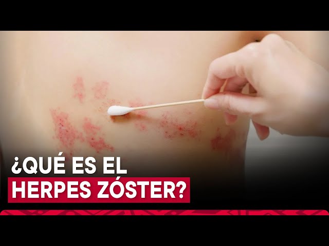 ⁣¿Tuviste varicela en la niñez? Así podría manifestarse el herpes zóster: ¡Toma nota!