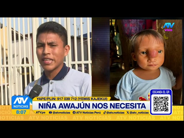 ⁣Niña awajún necesita de nuestra ayuda por grave tumor en su frente