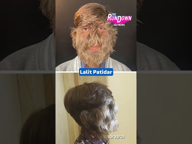 ⁣An 18-year-old from India officially has the world’s hairiest face  #itvnews #hair #worldrecord