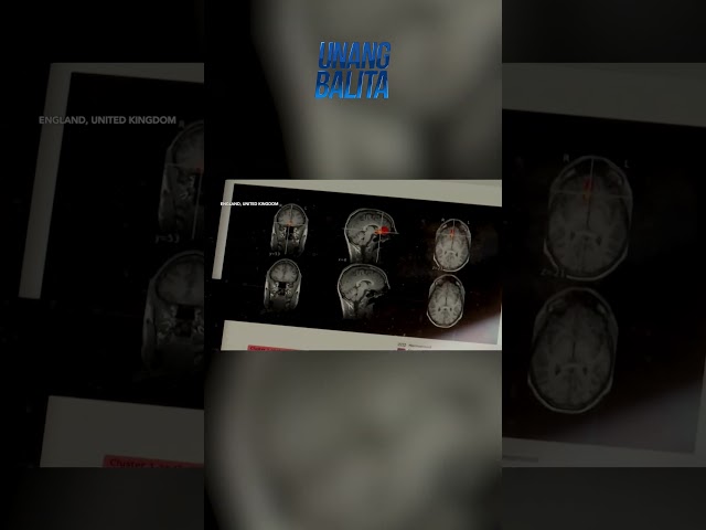 Abnormality sa utak na nagdudulot ng epilepsy, kaya ma-detect ng  A. I. ! #shorts l Unang Balita