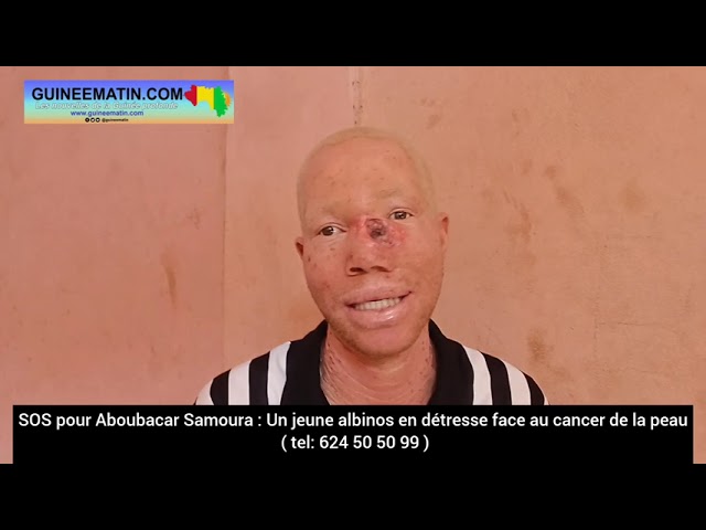 ⁣SOS pour Aboubacar Samoura, atteint d'un cancer de la peau : Tél : 624 50 50 99